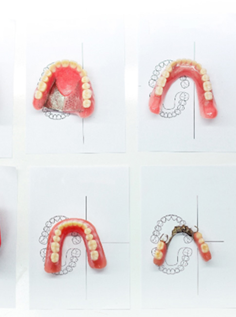 Different types of dentures