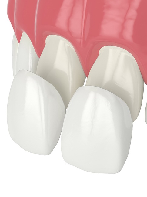 Illustration of veneers being placed on front teeth